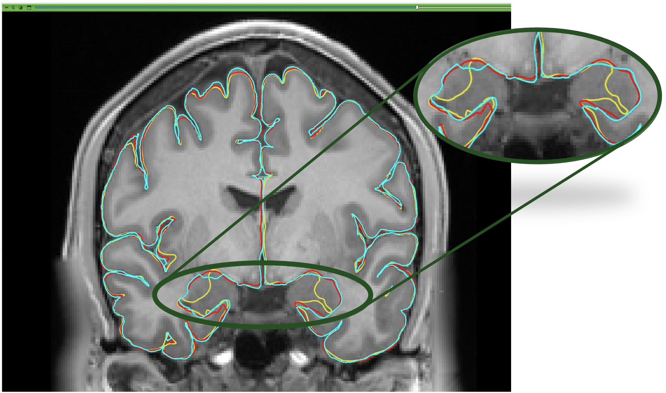 Zoomed-In Surface Overlay